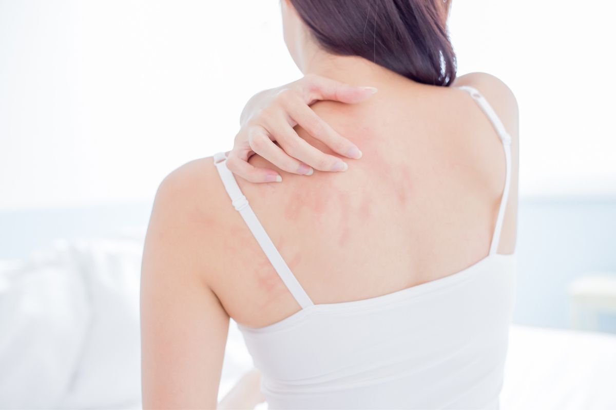 Argent Colloidal Eczema